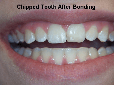 Chipped Tooth After Bonding - Dentistry in Pleasant Hill, MO