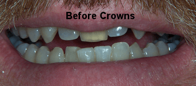 Before Crowns - Dentistry in Pleasant Hill, MO
