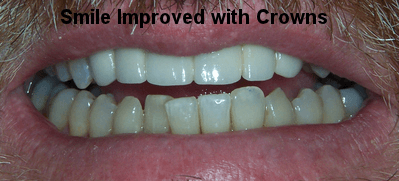 Smile Improved with Crowns - Dentistry in Pleasant Hill, MO