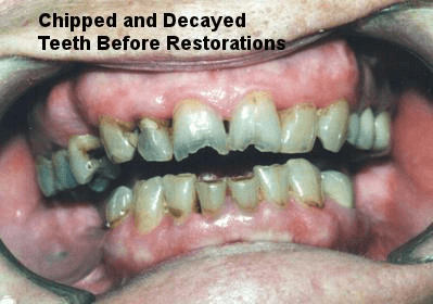 Chipped and Decayed Teeth Before Restorations - Dentistry in Pleasant Hill, MO