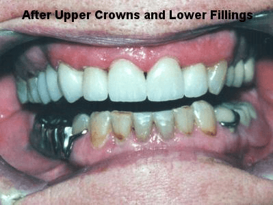 After Upper Crowns and Lower Fillings - Dentistry in Pleasant Hill, MO