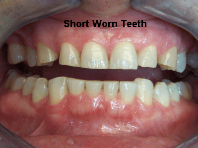 Short Worn Teeth - Dentistry in Pleasant Hill, MO