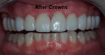 After Crowns - Dentistry in Pleasant Hill, MO