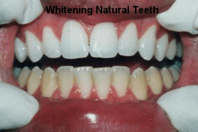 Whitening Natural Teeth - Dentistry in Pleasant Hill, MO