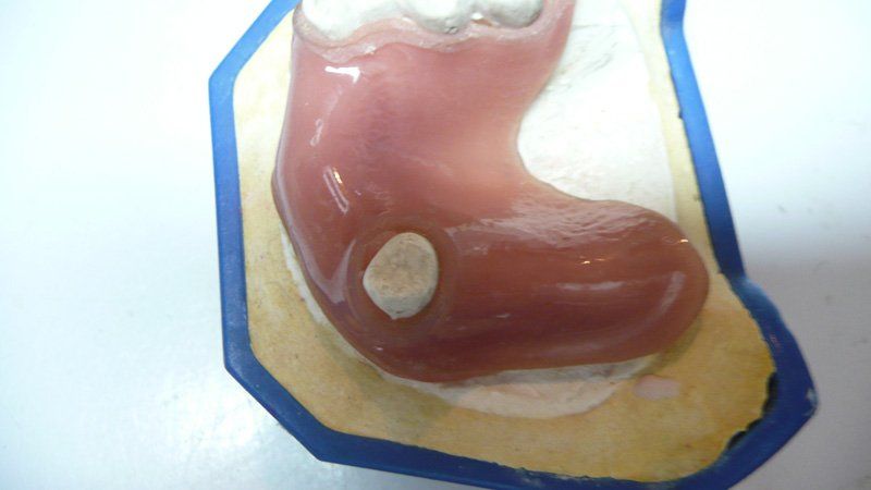 View of a denture being repaired