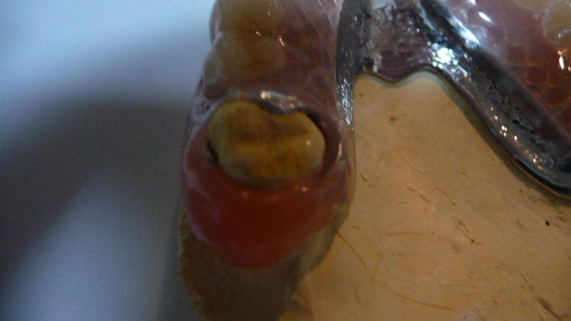 Closup of a denture