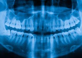 X-Ray Picture of the Teeth — Preventative Care in Lake Charles, LA