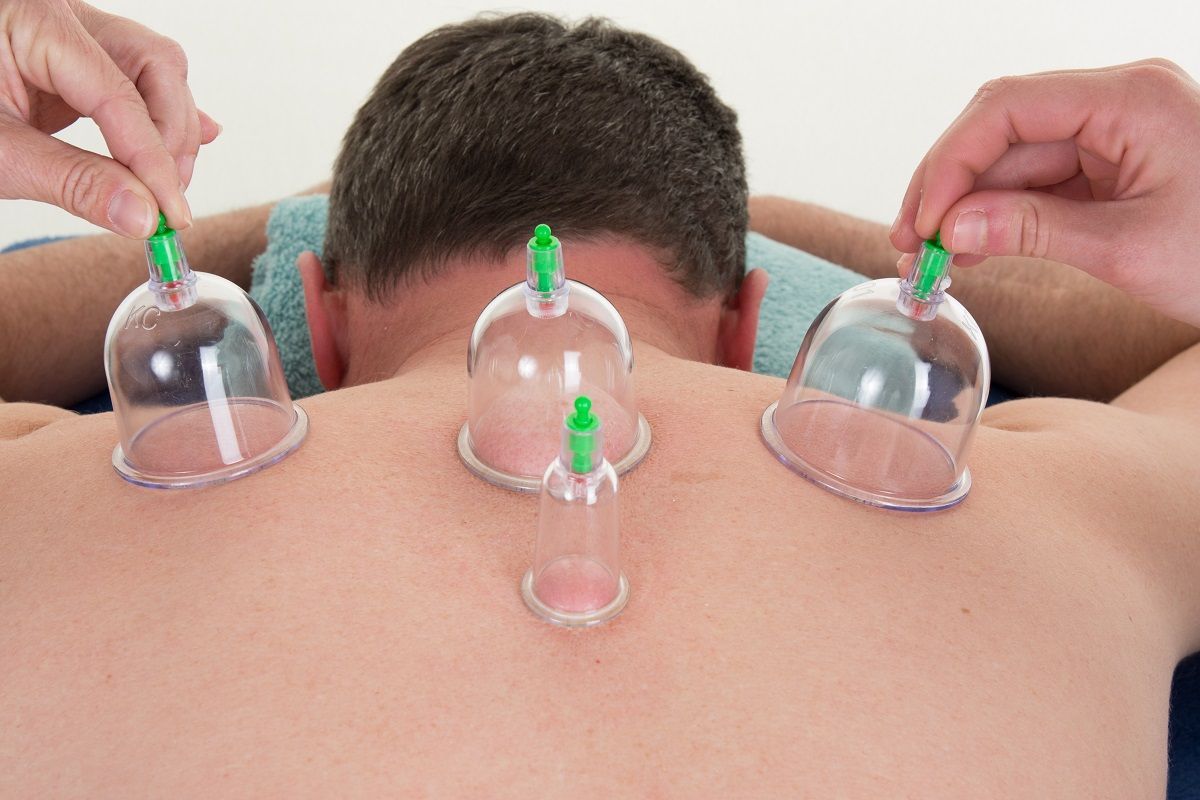 A person receiving cupping therapy on their back with four clear suction cups being placed by a practitioner.
