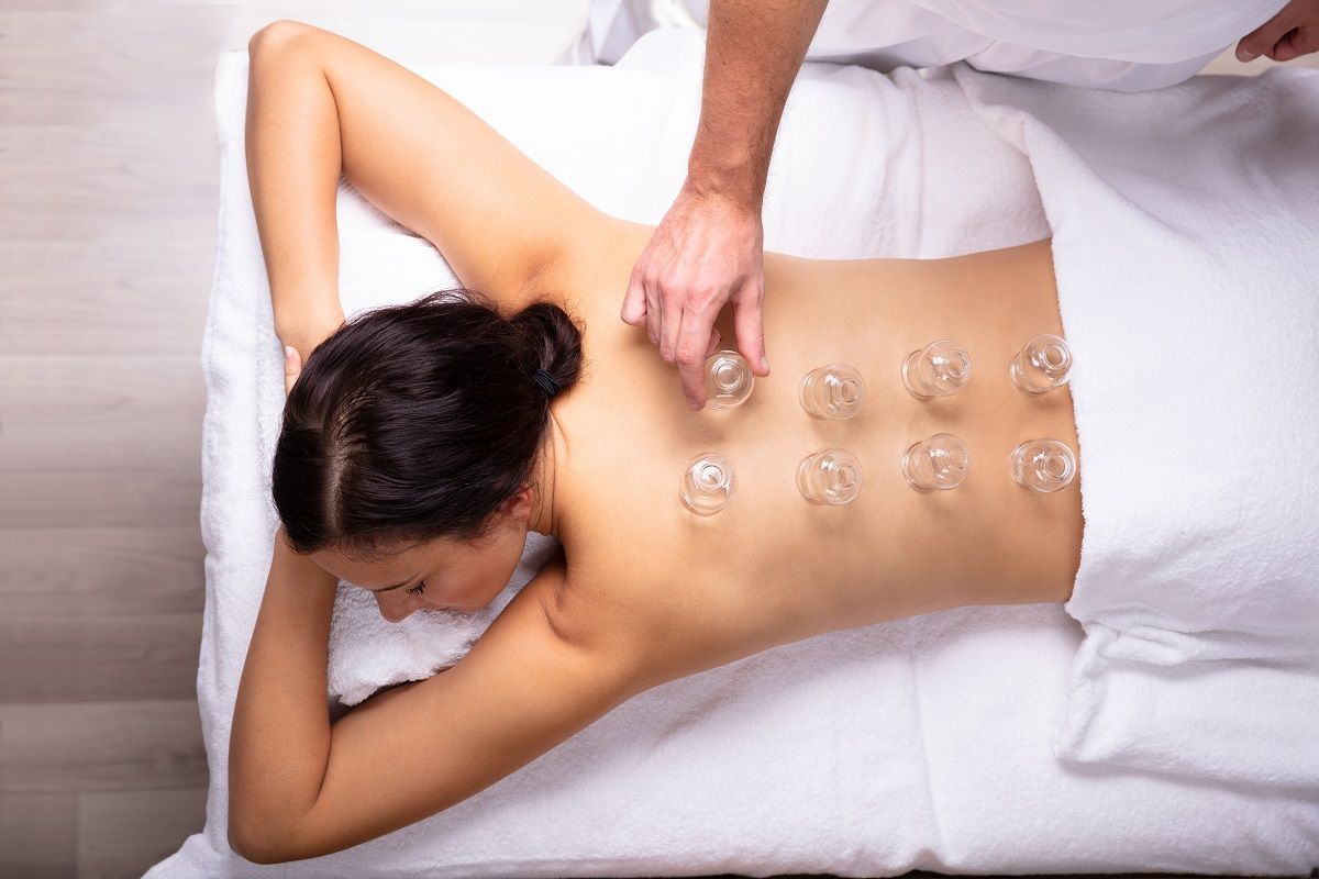 A practitioner places small, clear suction cups on a person's back during a cupping therapy session.