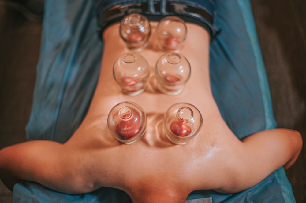 Six glass cupping therapy cups are placed on a person’s back, positioned symmetrically on a treatment table.