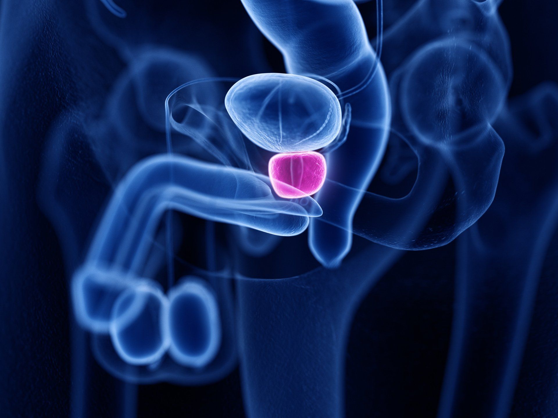 Depois da retirada da próstata, o câncer pode voltar?