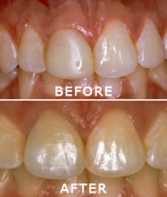 Before and After Restorative Treatment — Lutz, FL — Dr. William J Geyer Dr. Leslie Hernandez