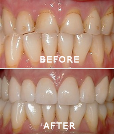 Before and After Cosmetic Treatment — Lutz, FL — Dr. William J Geyer Dr. Leslie Hernandez