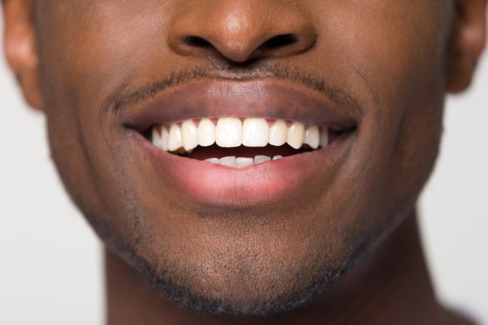 Close Up View of Orthodontic White Teeth — Lutz, FL — Dr. William J Geyer Dr. Leslie Hernandez