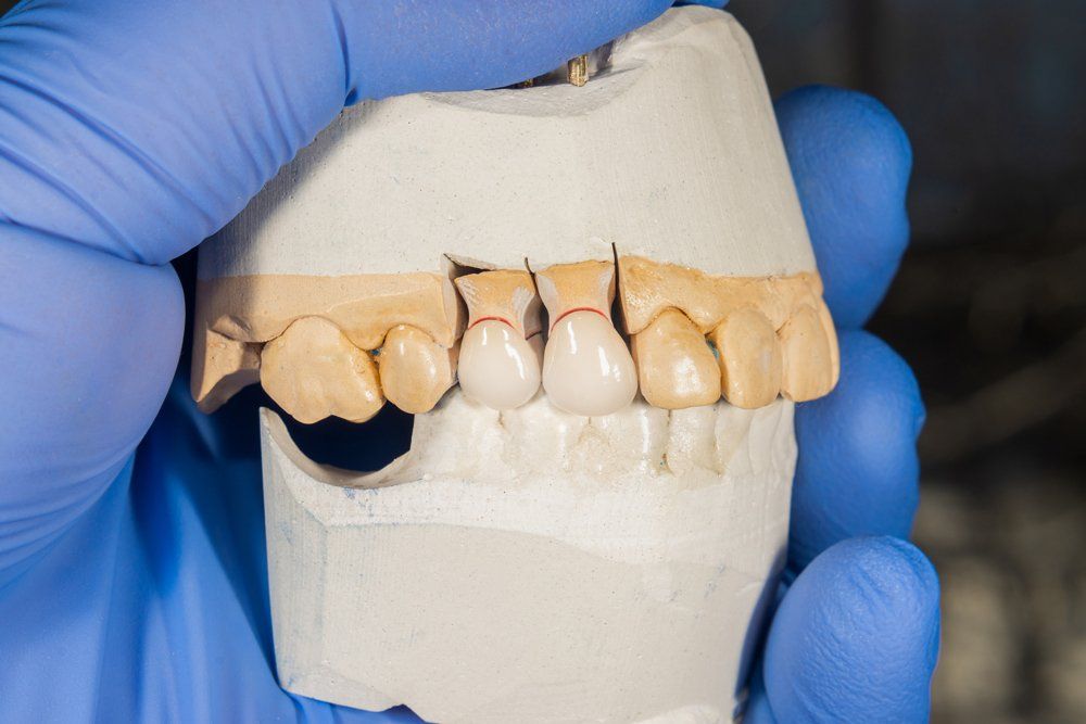 Prosthodontic Sample — Lutz, FL — Dr. William J Geyer Dr. Leslie Hernandez