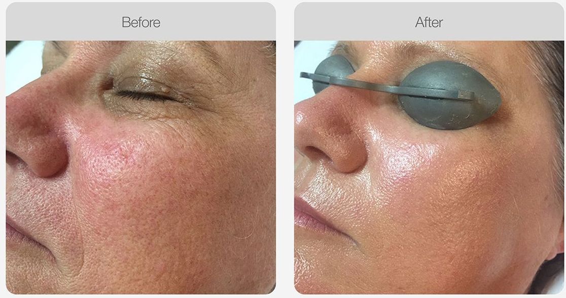 A woman is receiving laser rejuvenation – Rapid Creek, NT - Urban Wax & Beauty