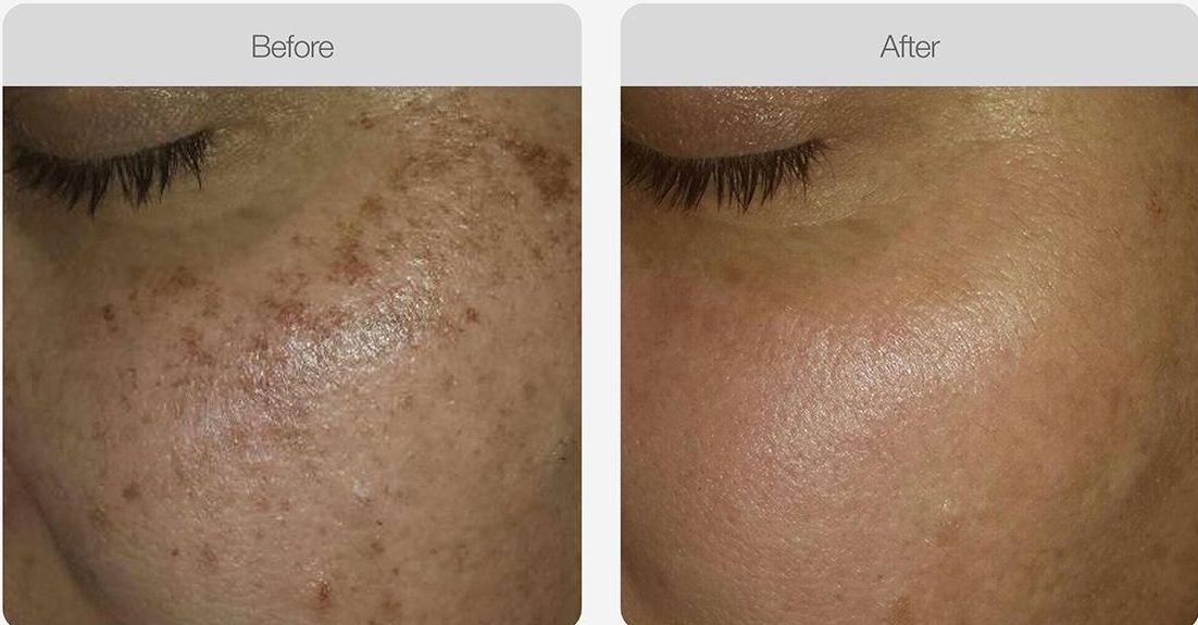 A woman is getting a laser treatment on her face – Rapid Creek, NT - Urban Wax & Beauty