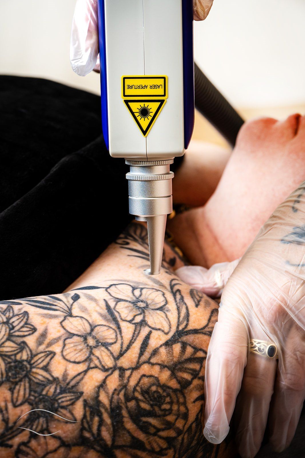 A person is getting a tattoo removed from their back – Rapid Creek, NT - Urban Wax & Beauty