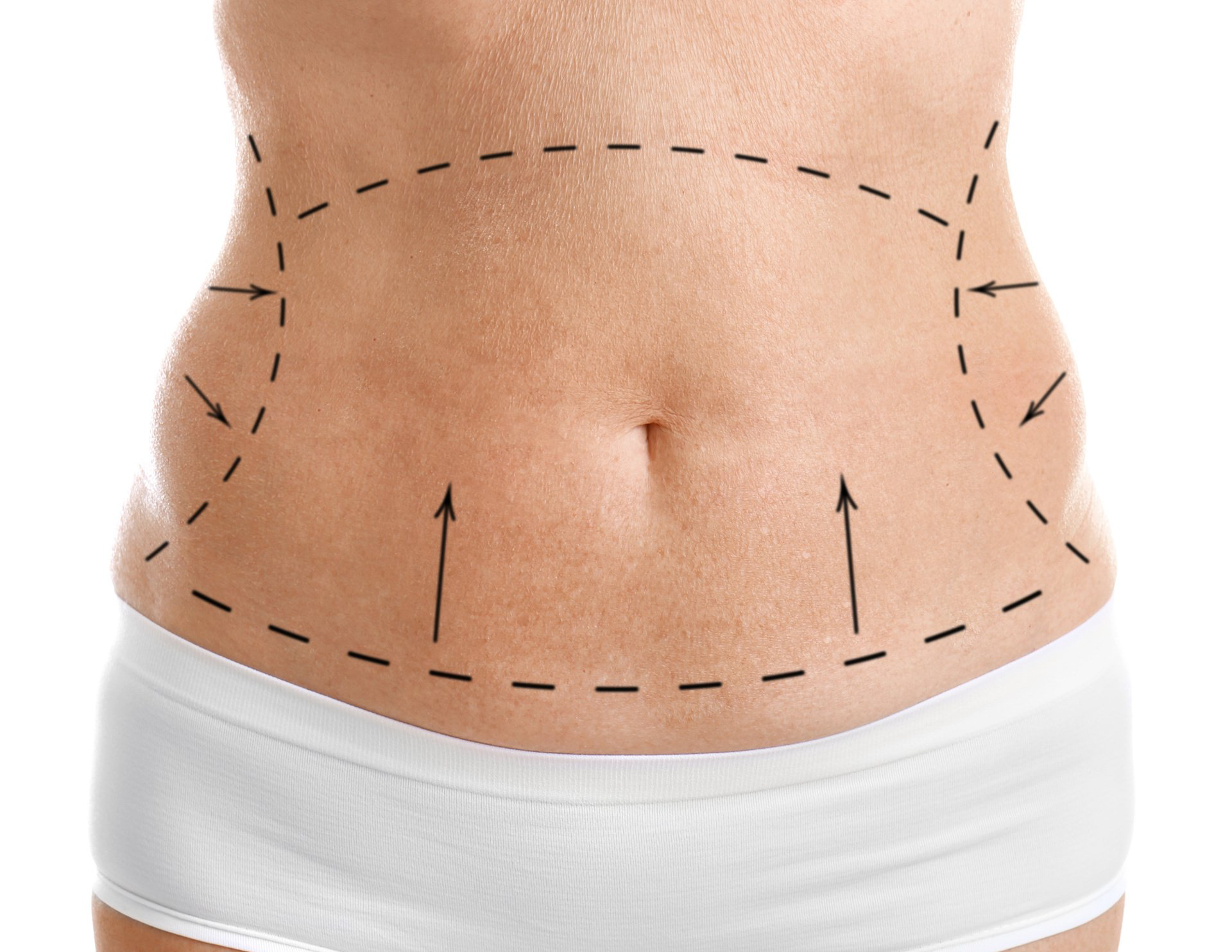 Como funciona a abdominoplastia Como funciona a abdominoplastia