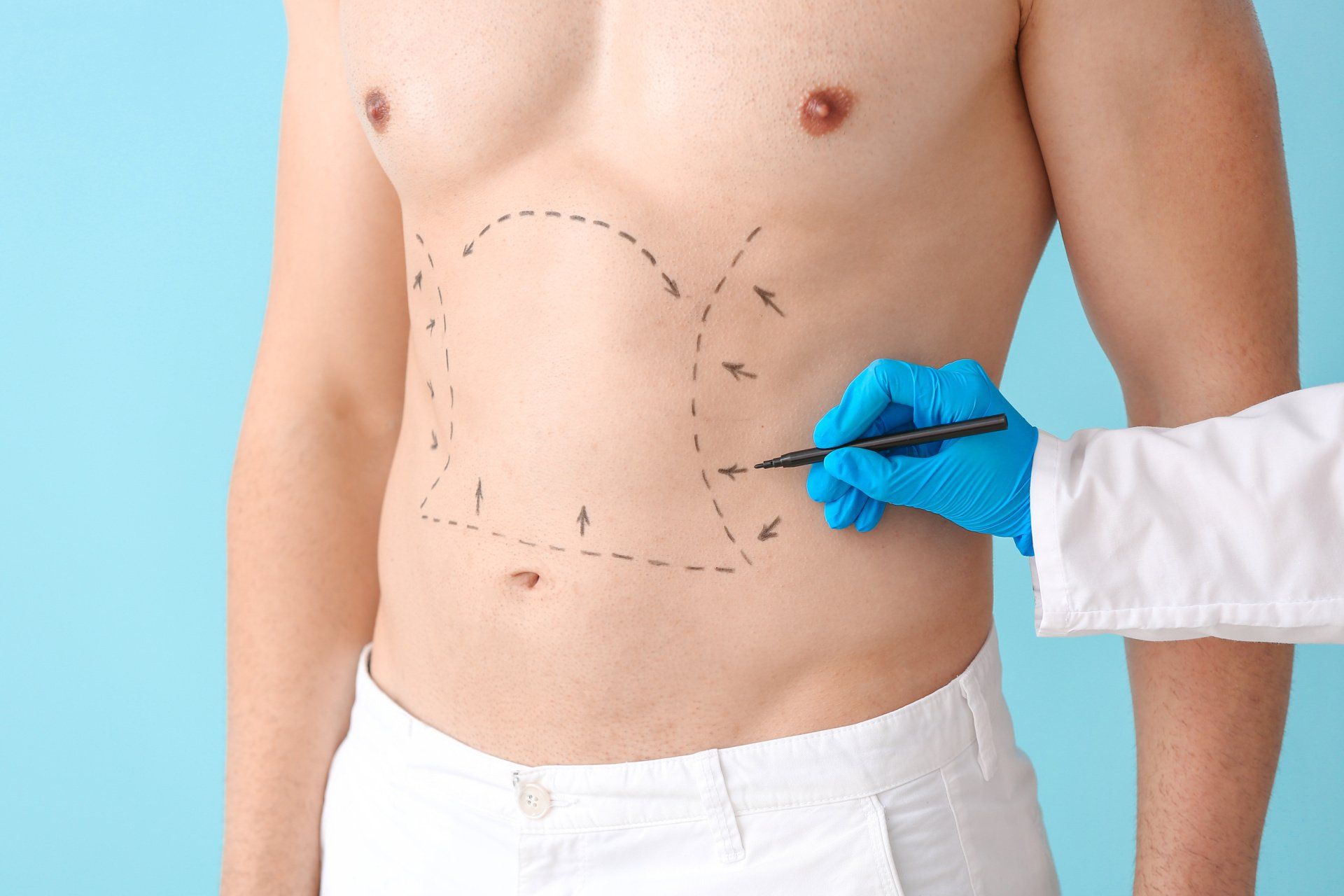 Quando é indicado que um homem faça lipoaspiração a laser Quando é indicado que um homem faça lipoaspiração a laser
