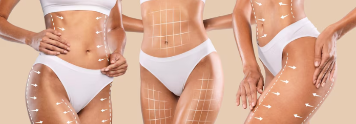 Quais áreas do corpo são tratadas com a lipoabdominoplastia MILA