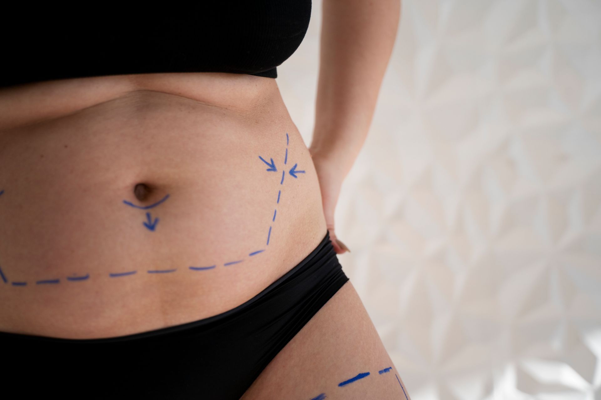 Qual e o tempo de recuperacao para a lipoabdominoplastia MILA