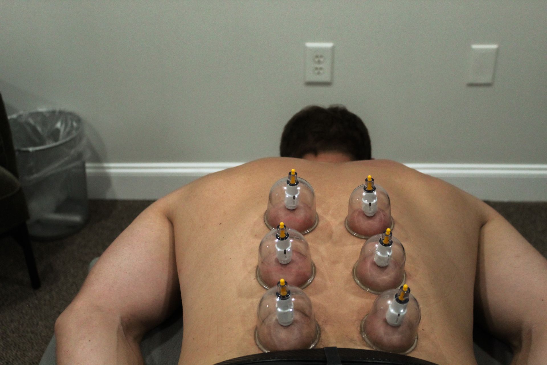 A man with cupping therapy on his back, standing by a chalkboard with game scores.