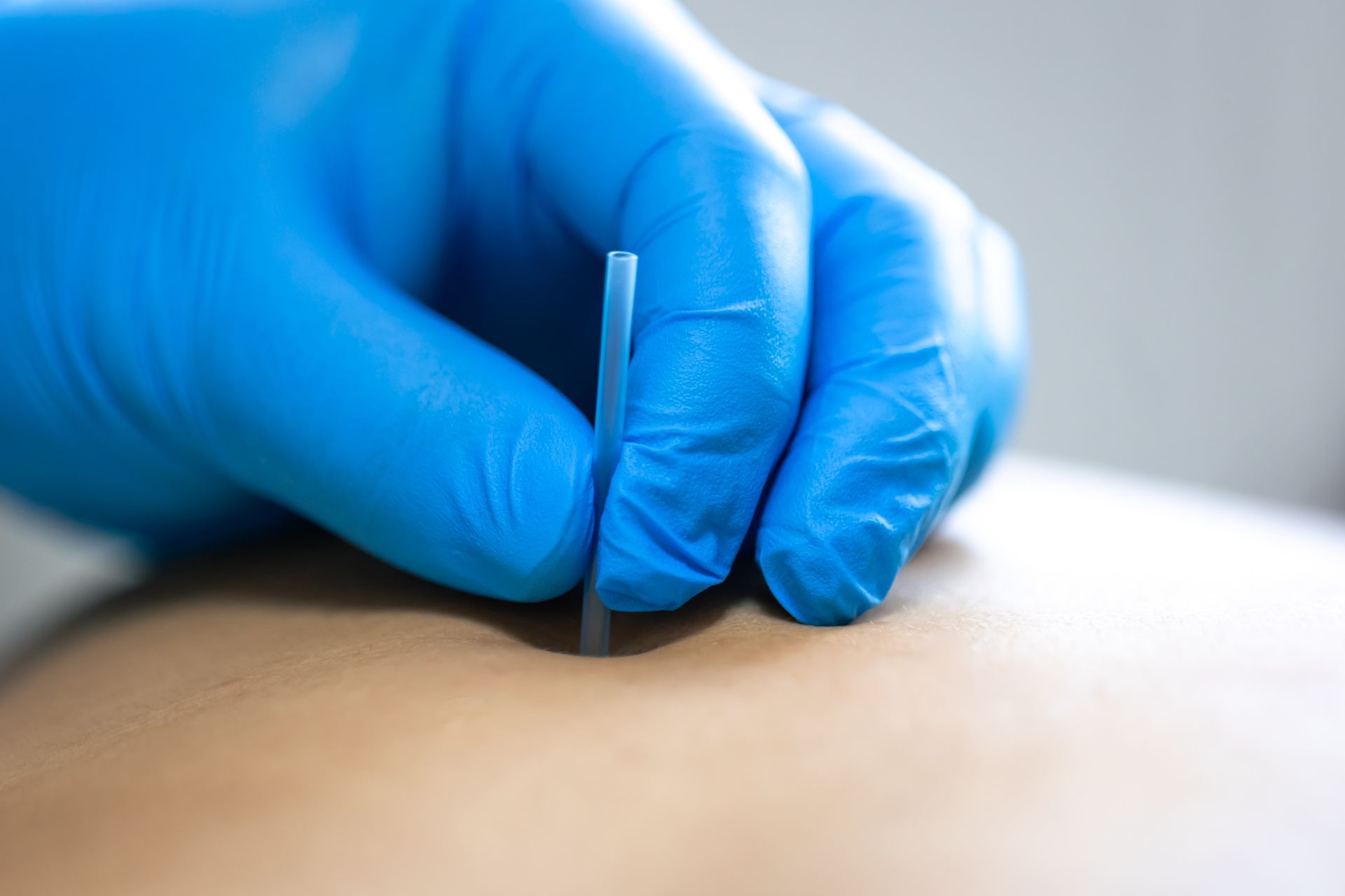 Person receiving acupuncture on their back; needles inserted by a practitioner.