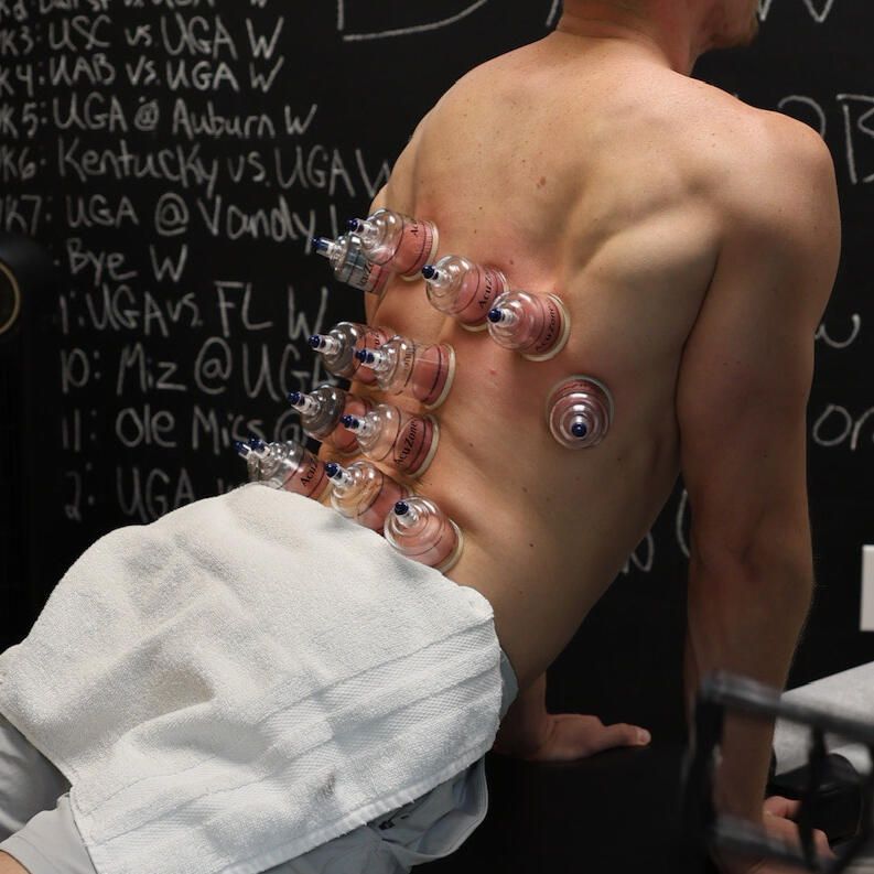 Man's back with cupping therapy, red marks visible. Blackboard with game schedule in background.