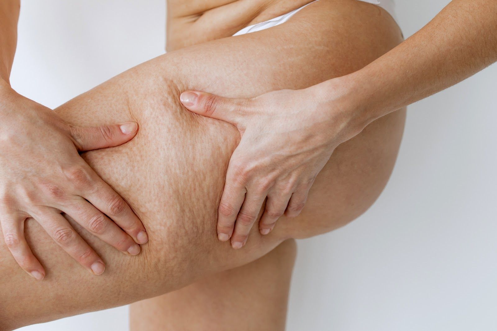 Person's hand pinching the thigh, showcasing skin texture with visible cellulite against a white background.
