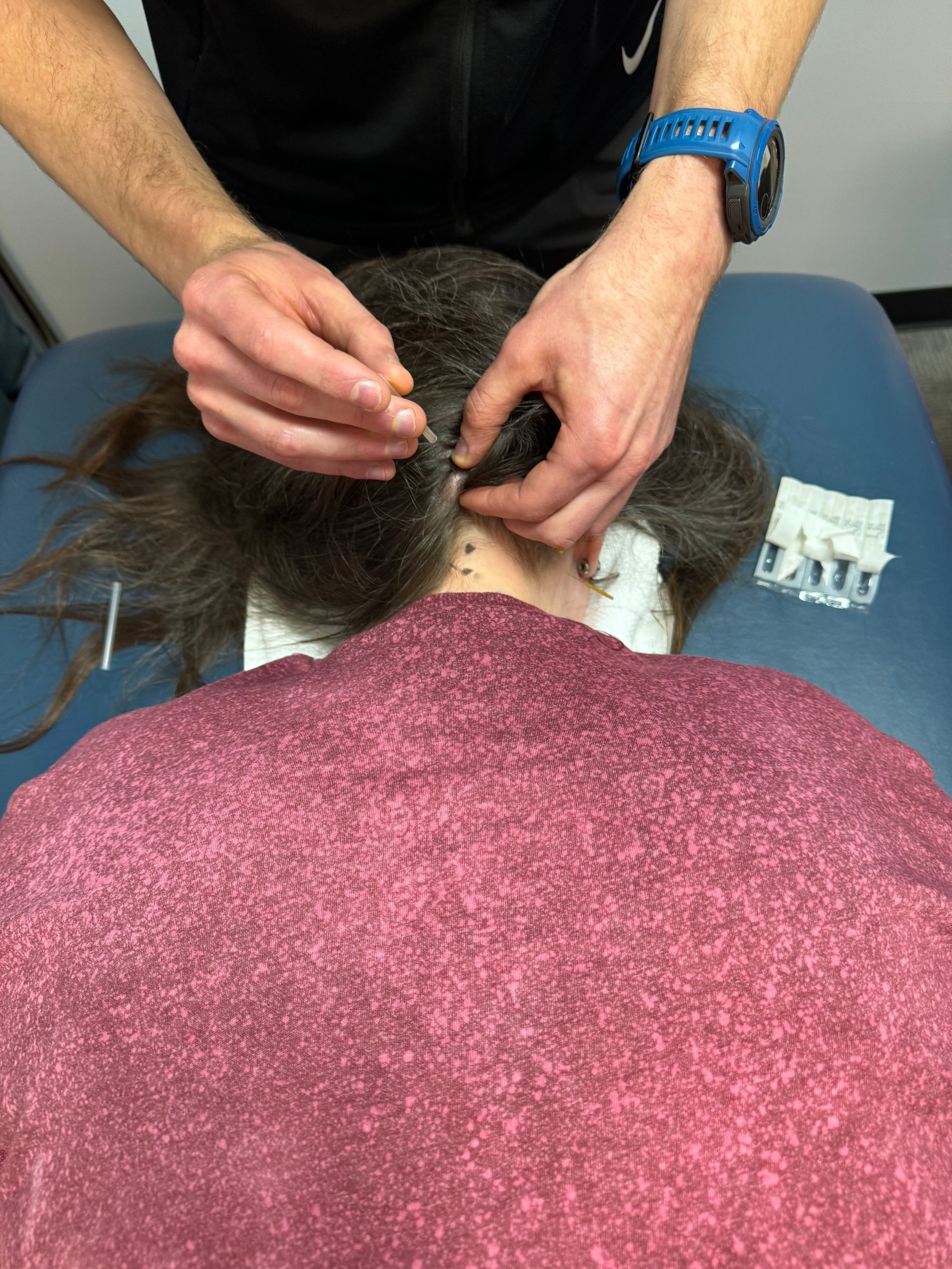 A person is laying on a table getting acupuncture from a doctor.