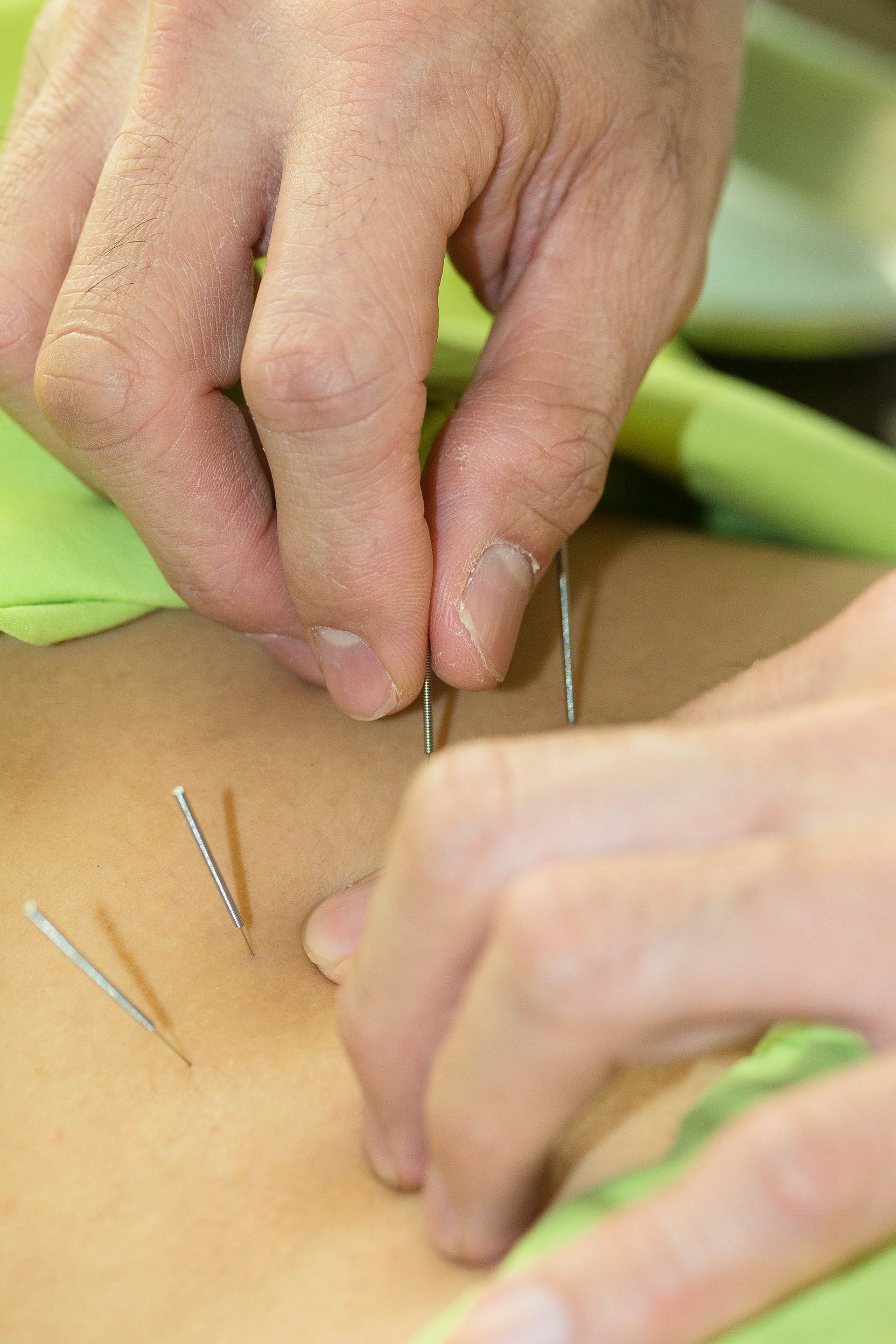 A person is getting acupuncture on their back.