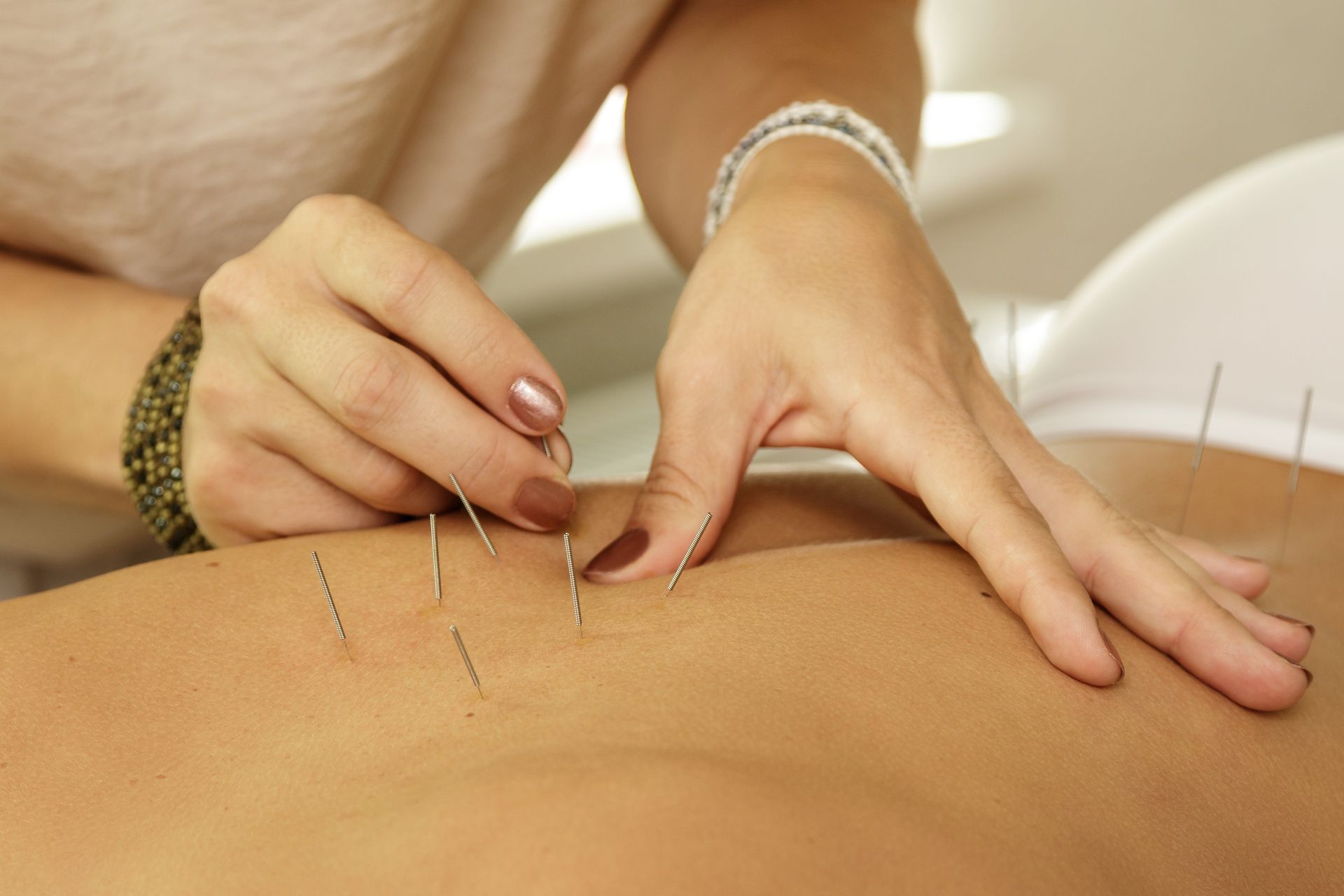 A person is getting acupuncture on their back.