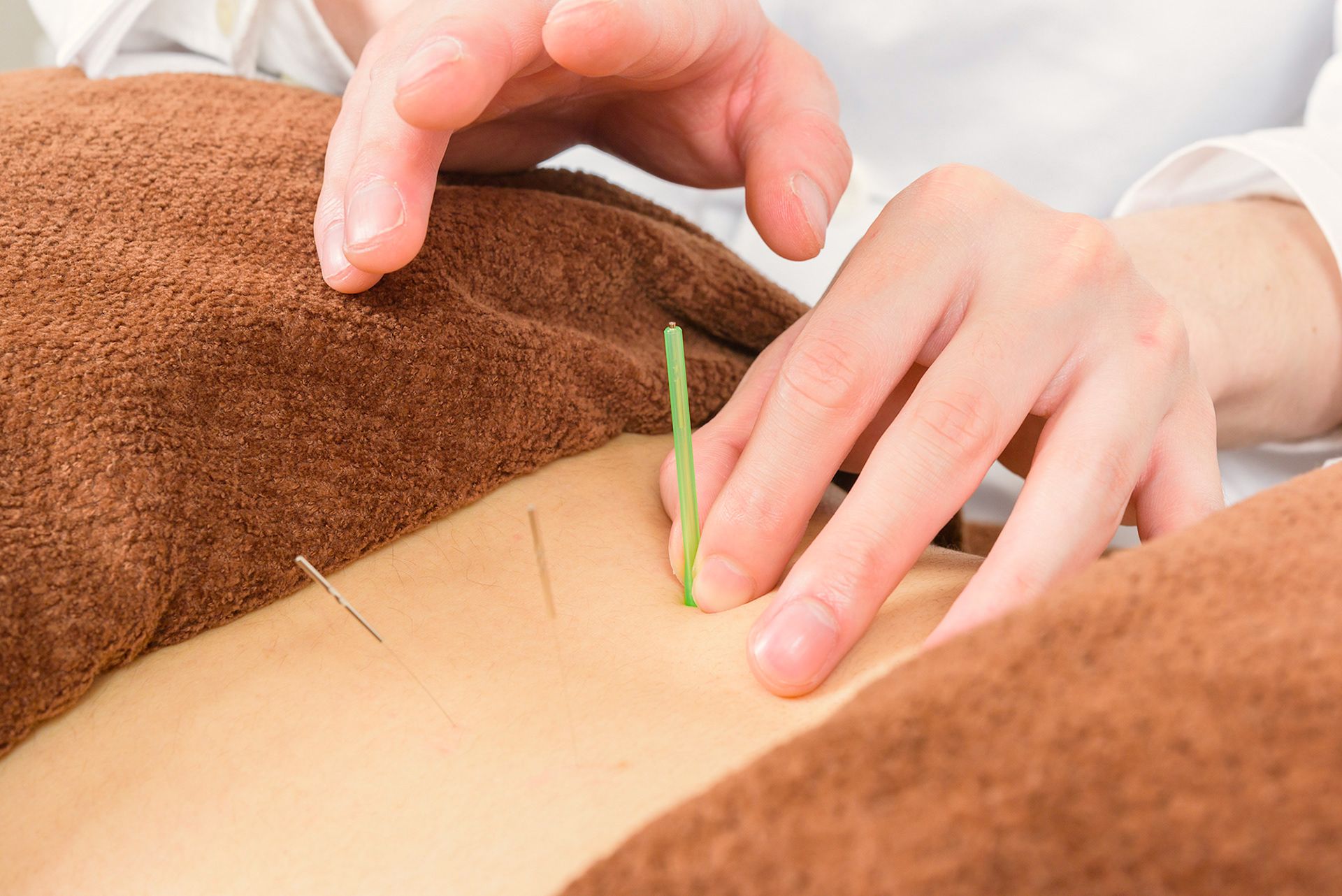 A person is getting acupuncture on their back.