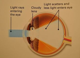 Cataract Facts, Altoona Ophthamology, Altoona, PA