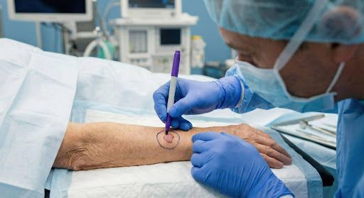  cirurgia de mohs