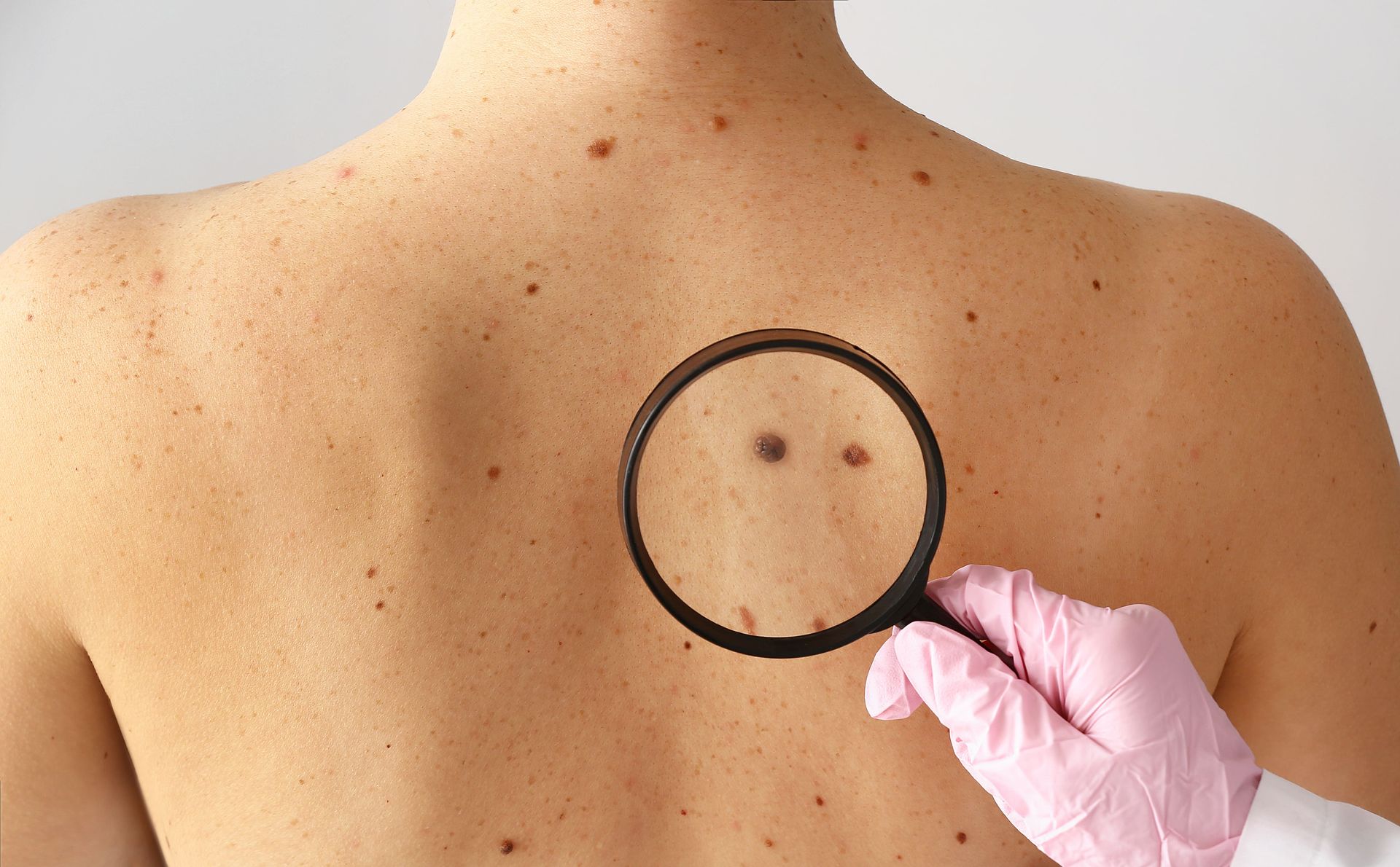 especialista melanoma