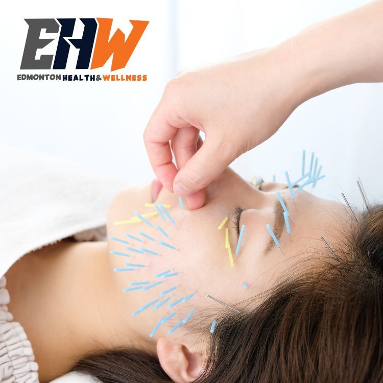 Therapist doing Acupuncture on a woman's face