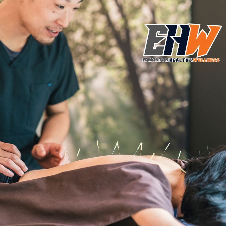 Therapist doing Acupuncture on a woman's back