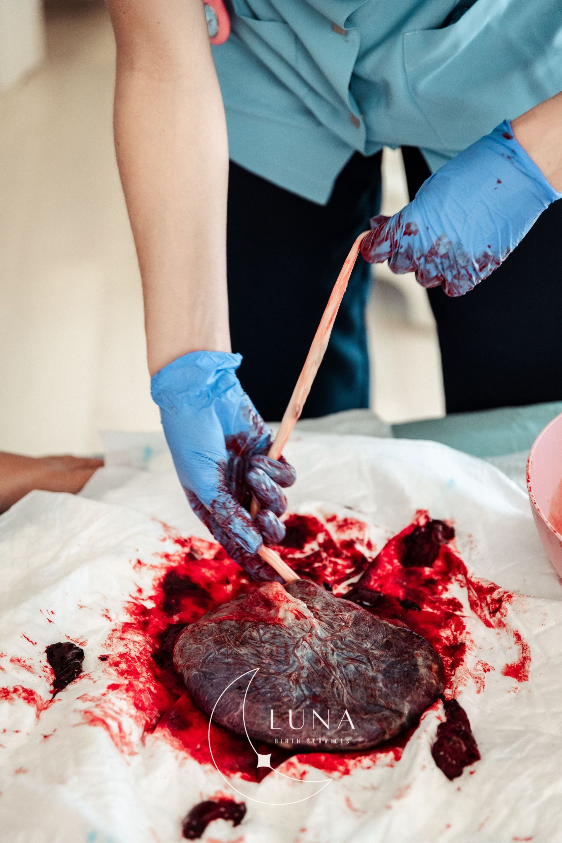 Profesional médico manipulando una placenta cubierta de sangre con cordón umbilical, sobre un campo médico.