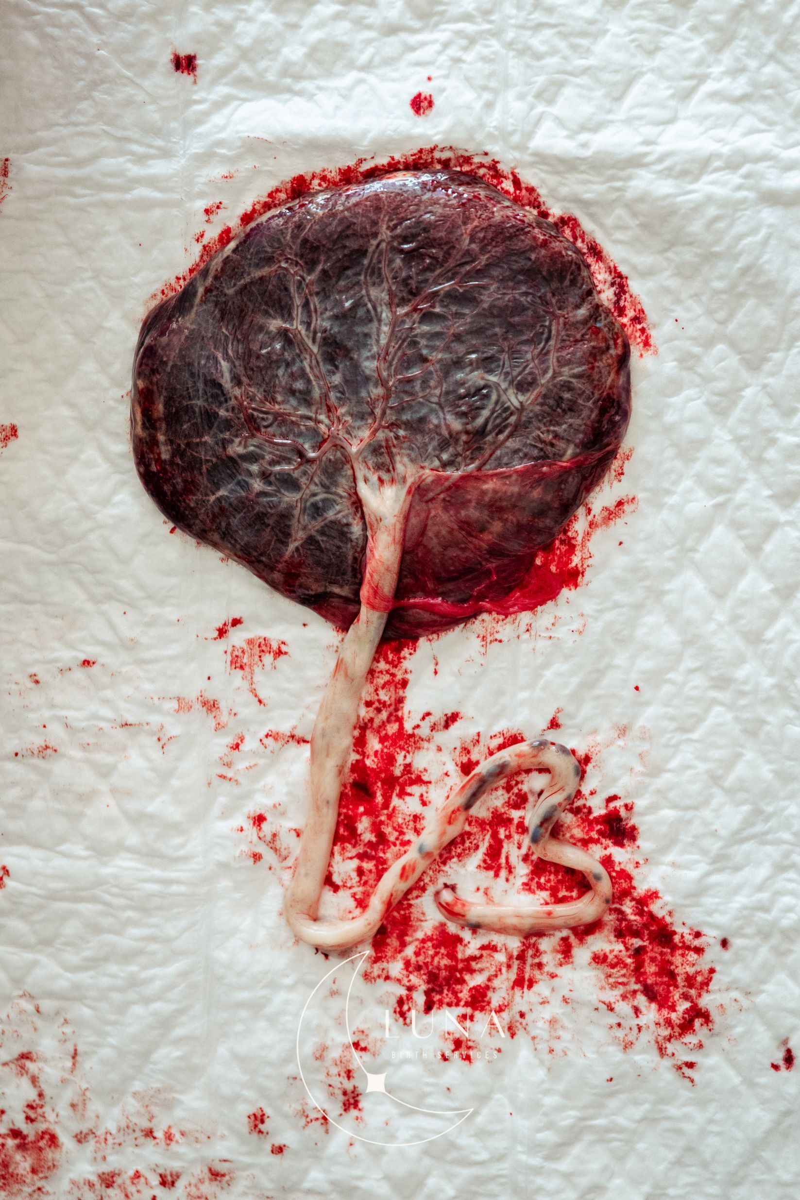 Una placenta humana y un cordón umbilical, con sangre sobre una superficie blanca.