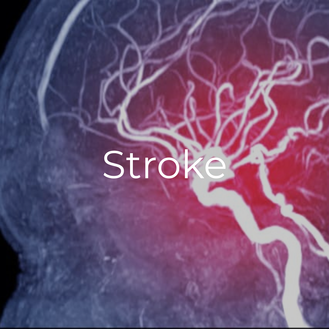 An x-ray of a person 's brain showing a stroke