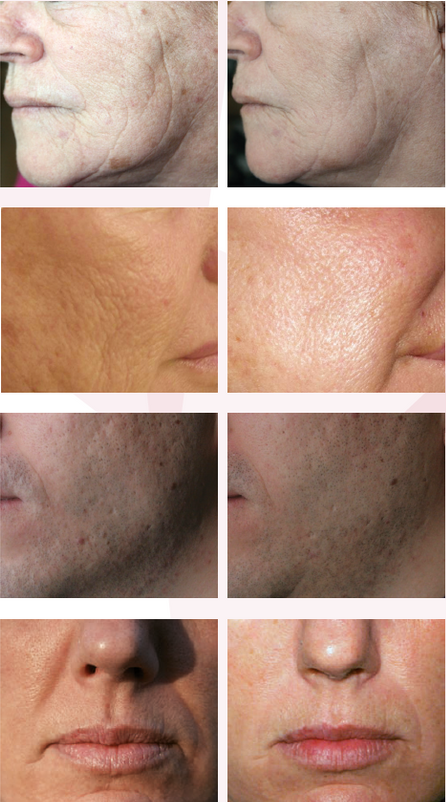 Ein Vorher-Nachher-Foto vom Gesicht einer Frau