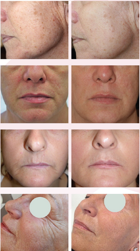 Das Gesicht einer Frau wird vor und nach einer Behandlung gezeigt.