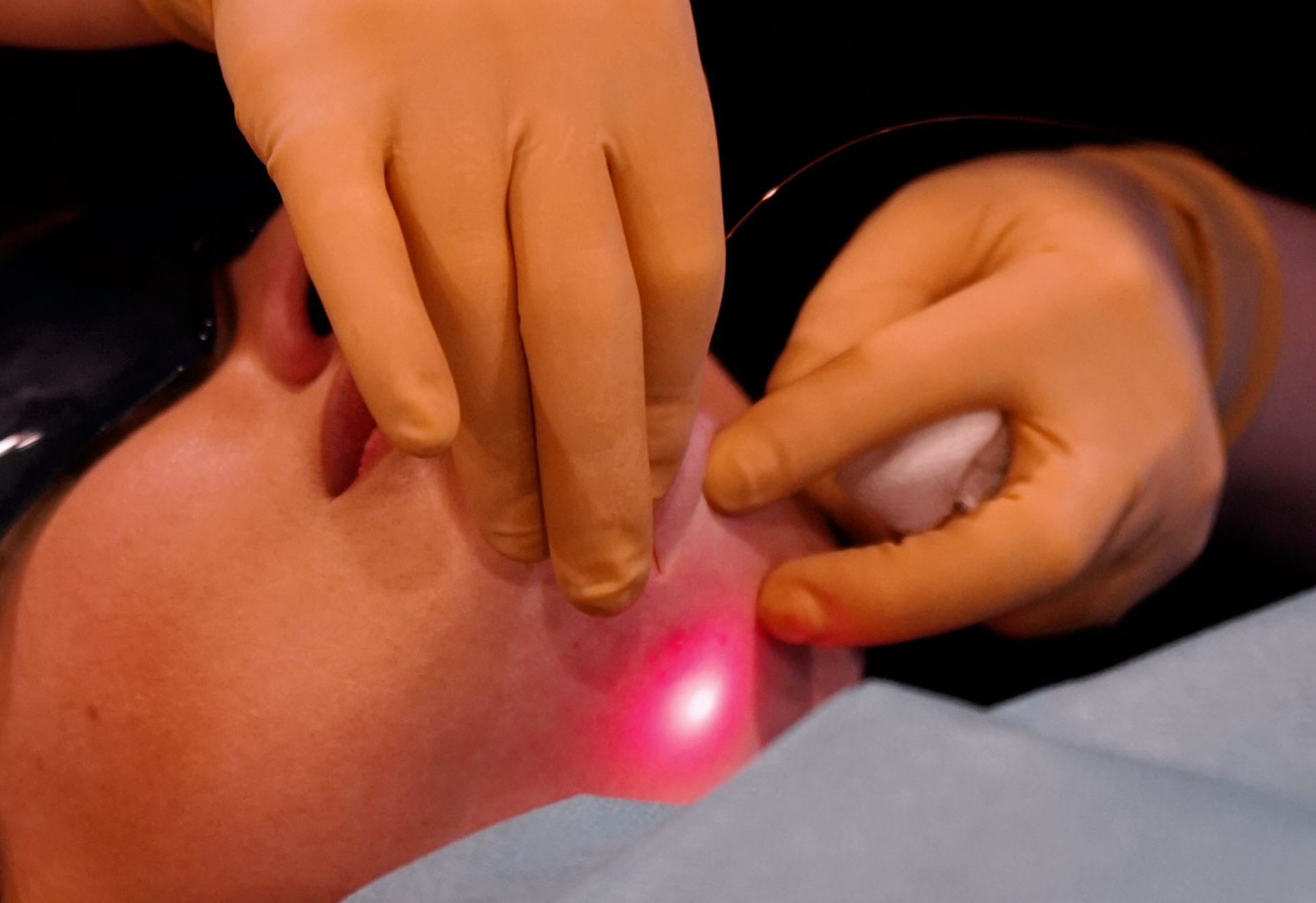 Dr. Ancuta Hutuleac führt eine Endolift Laserbehandlung bei einer Patientin in Düsseldorf durch – minimalinvasive Hautstraffung und Anti-Aging ohne OP bei I ME MINE.