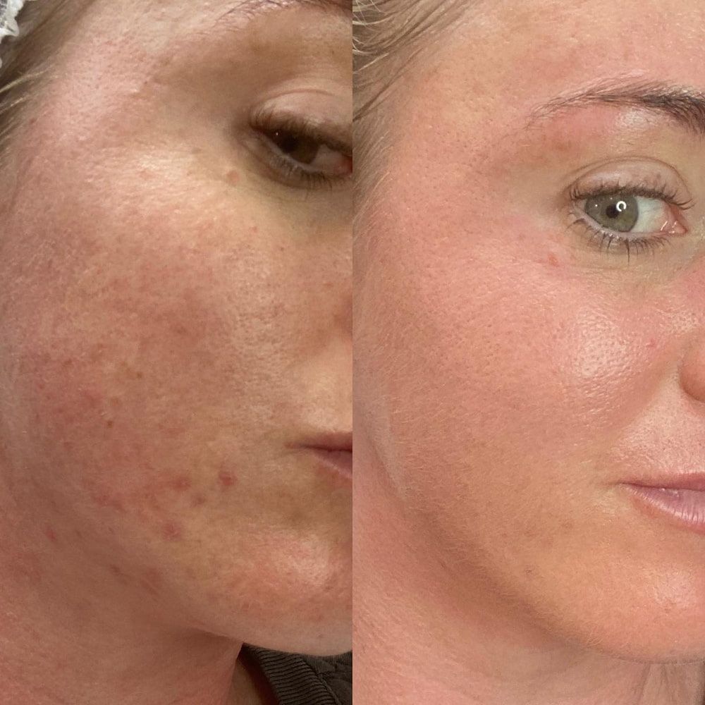 Before and After Photos of a Woman's Face — Eternal Radiance in Strathmore, VIC