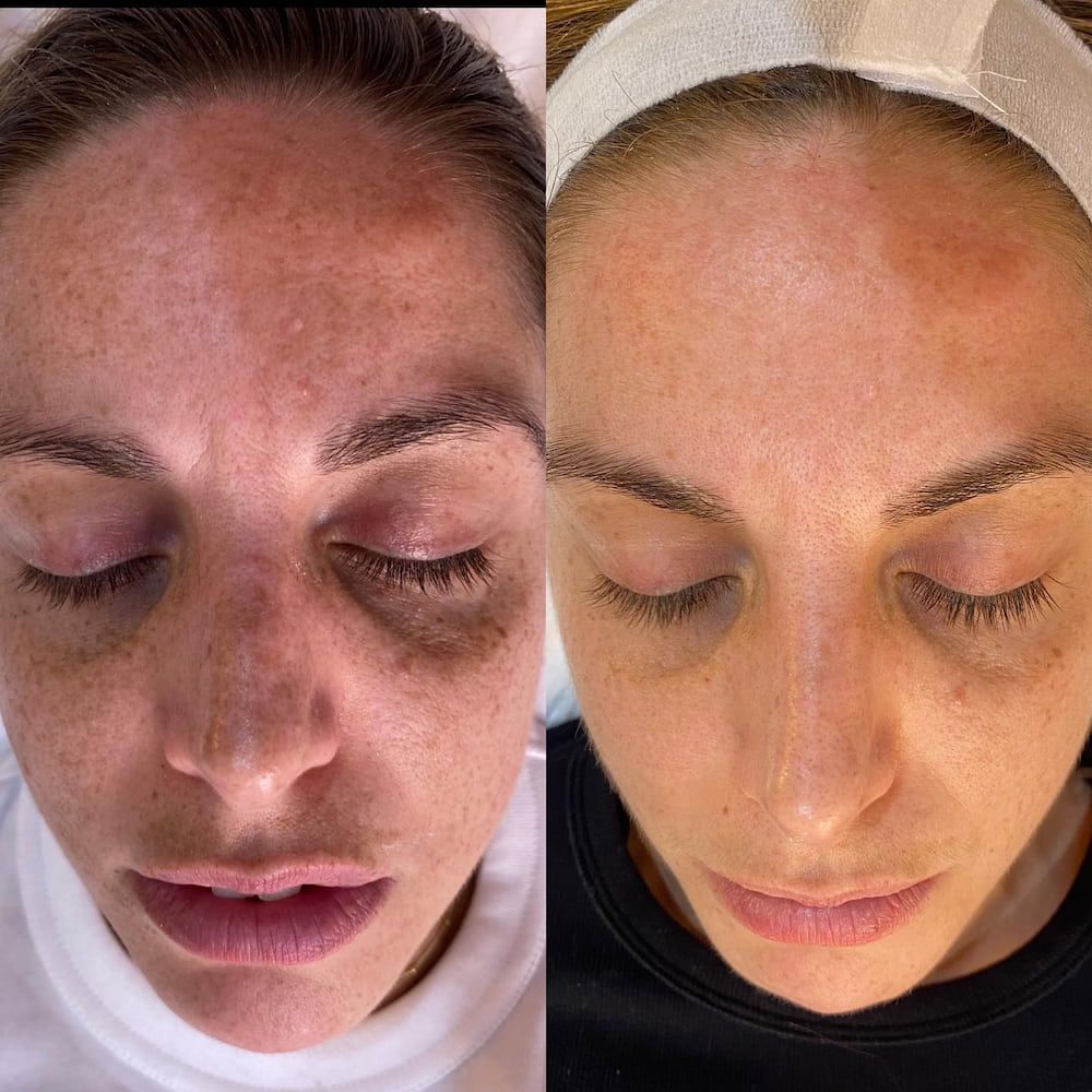 Side-by-side Comparison of a Woman's Face: Before and After Skin Treatment — Eternal Radiance in Strathmore, VIC