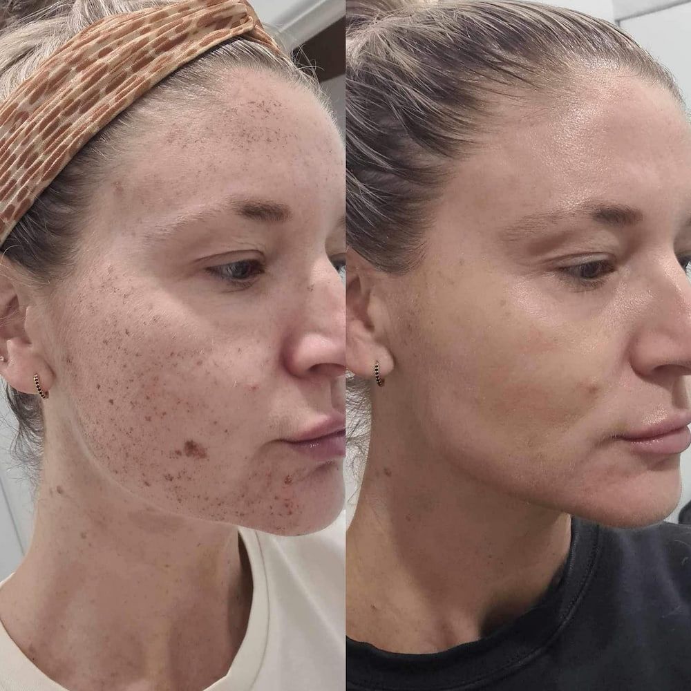 Before and After Photos of a Woman's Face Showing Improved Skin Tone After a Treatment — Eternal Radiance in Strathmore, VIC