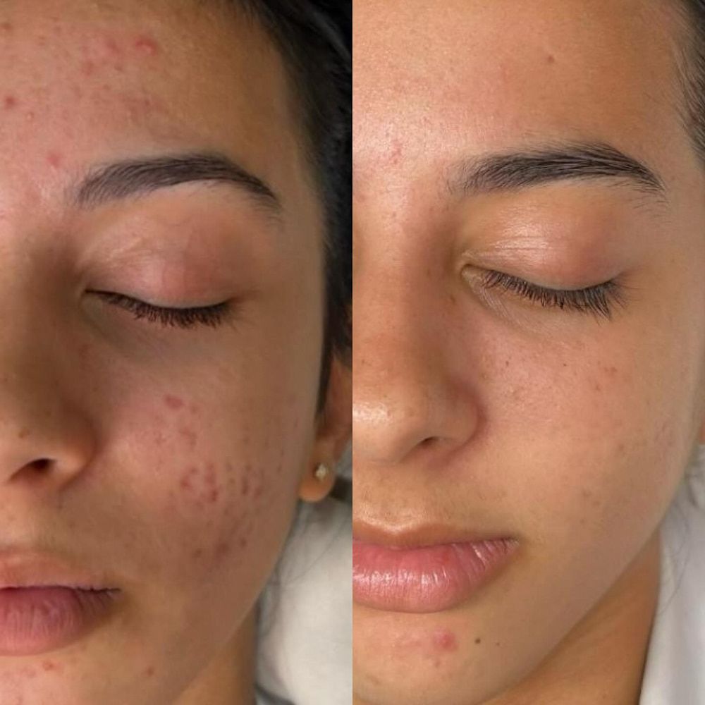 Side-by-side Comparison of a Woman's Face. Left: Acne — Eternal Radiance in Strathmore, VIC
