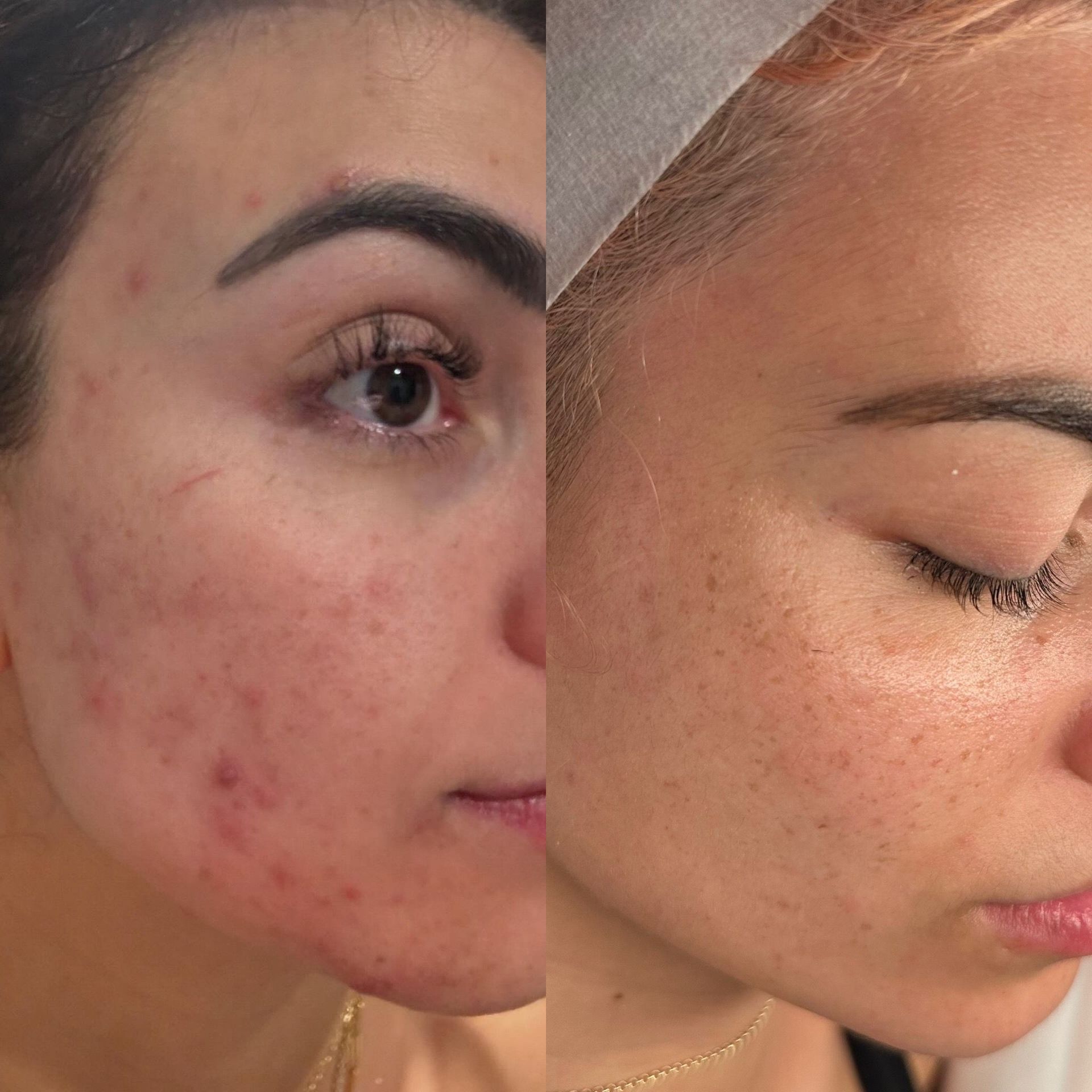 Woman With Smooth Skin, Smiling, Hand Touching Cheek — Eternal Radiance in Strathmore, VIC